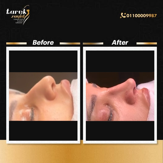 عمليات تجميل الأنف قبل وبعد